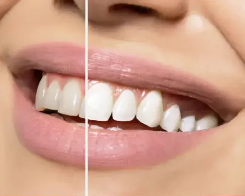 Blanchiment dentaire Avant/Après